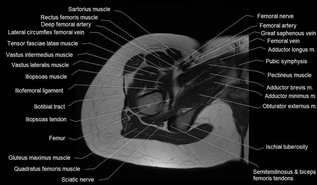 MRI thigh cross sectional anatomy image 12.webp